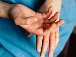 Spongiotic dermatitis, What is spongiotic dermatitis, Spongiotic dermatitis treatment, Spongiotic dermatitis pictures, Spongiotic dermatitis causes