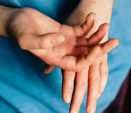Spongiotic dermatitis, What is spongiotic dermatitis, Spongiotic dermatitis treatment, Spongiotic dermatitis pictures, Spongiotic dermatitis causes