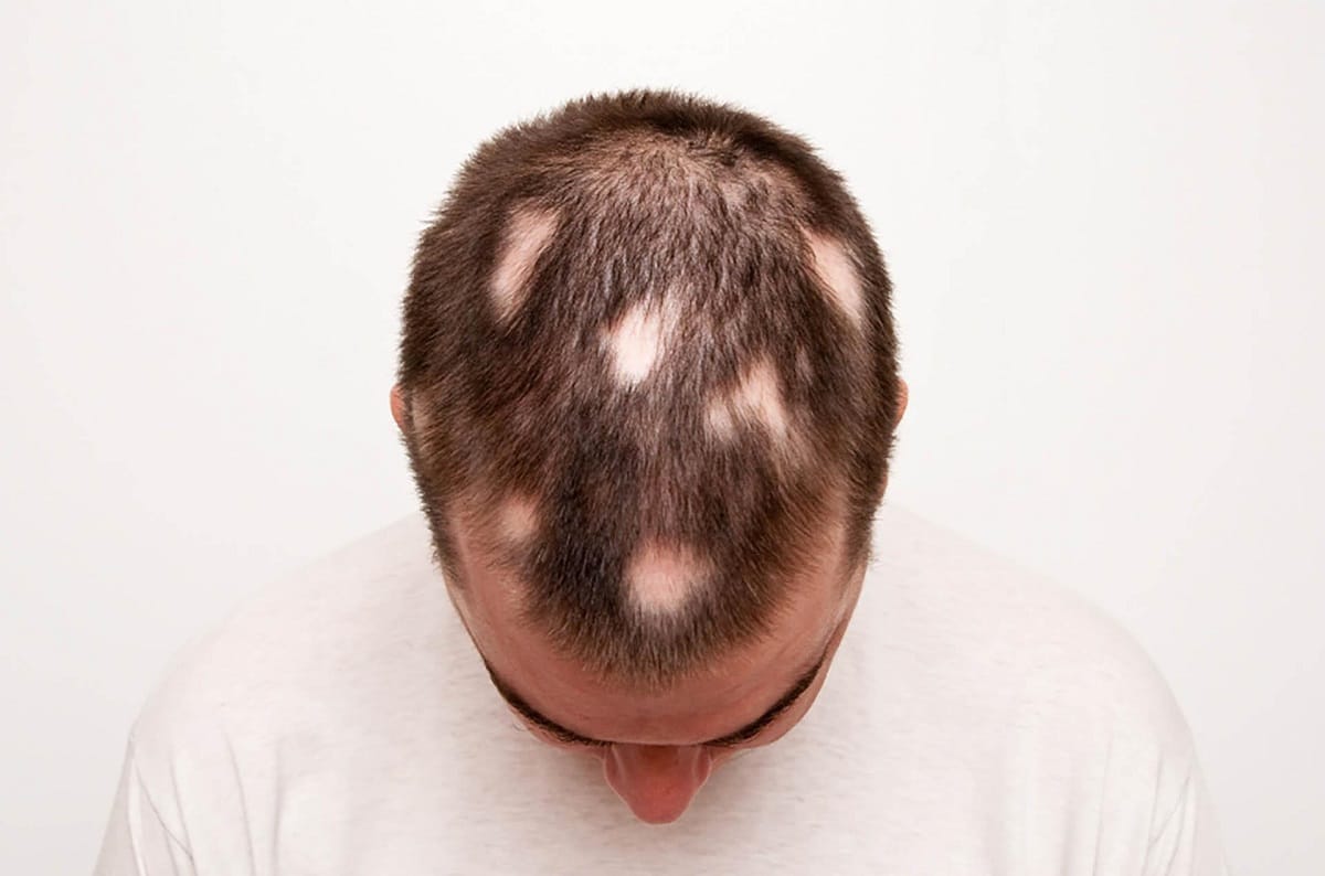 Homeopathic remedies for alopecia areata