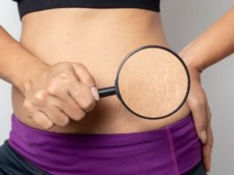 How to Remove Stretch Marks Permanently