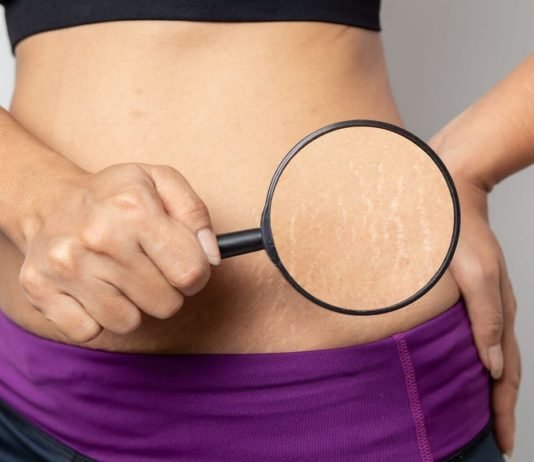How to Remove Stretch Marks Permanently