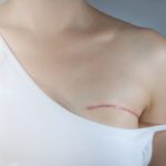 How To Regain Your Confidence After A Mastectomy