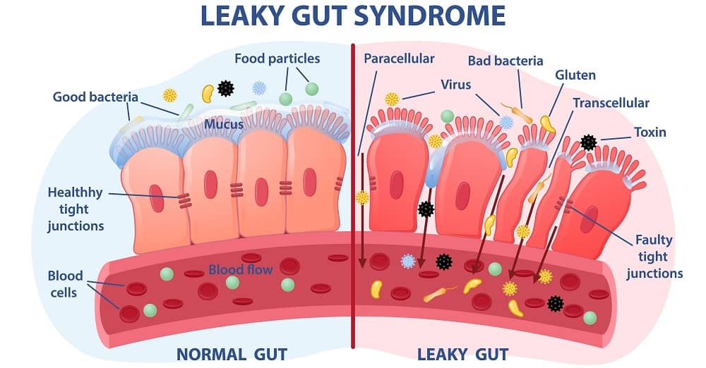 Signs Of Leaky Gut Syndrome