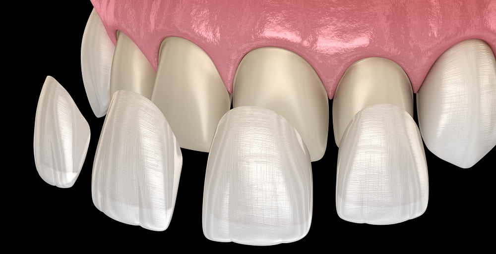 Dental veneers impact on your social life-min