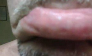 fordyce-spots-on-lips-pictures