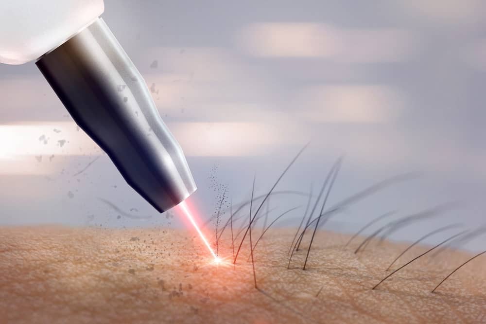 Why Choose Laser Hair Removal Over Traditional Methods