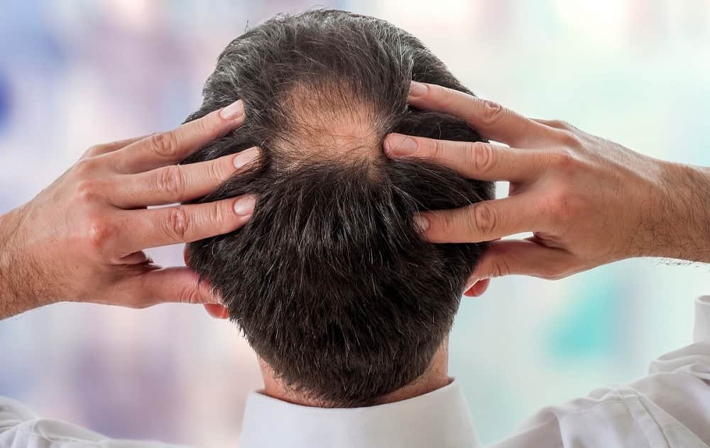 Male Hair Loss