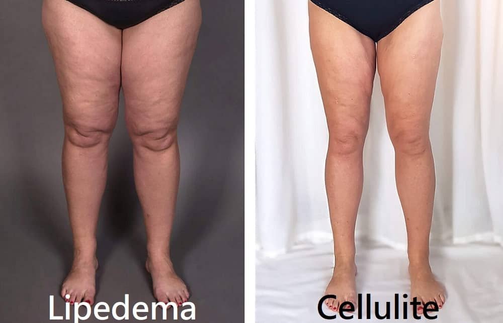 lipedema vs cellulite pictures