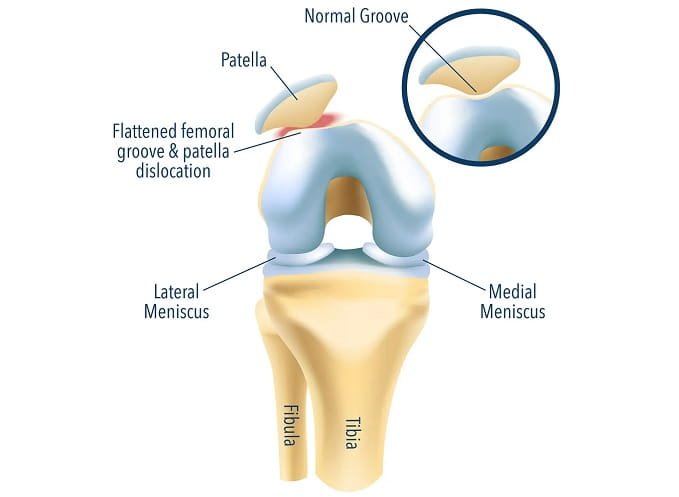 What is The Patellofemoral Pain Syndrome